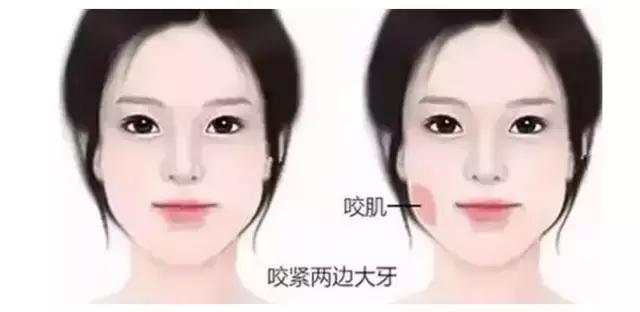 解密瘦脸针的几大常识性问题,关于瘦脸针的真实事件