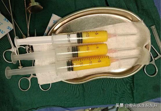 自体脂肪丰太阳穴多久才能恢复,自体脂肪丰太阳穴多久恢复正常