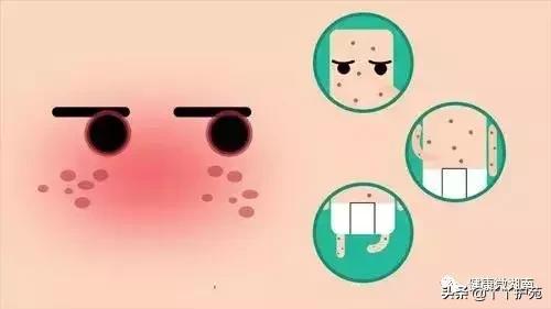 风疹为啥不让见风,风疹民间说法