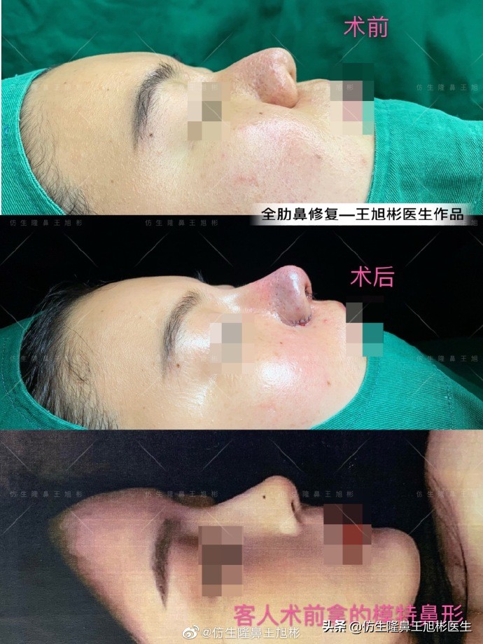 鼻翼整形矫正过程,鼻整形鼻尖下垂怎么办