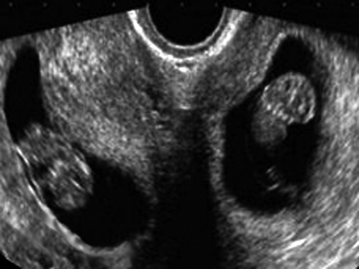 孕检超声检查对照表,明明白白做ct检查