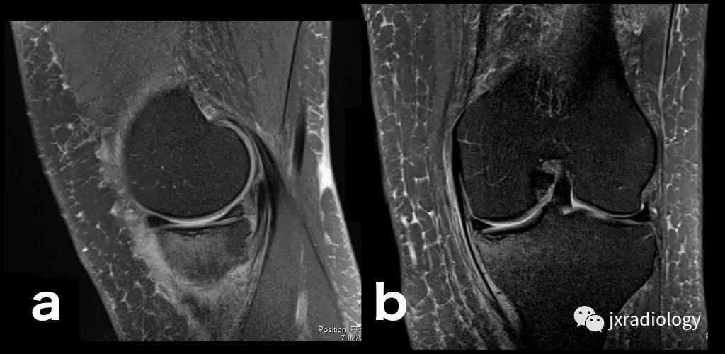 磁共振天天诊断骨髓水肿，但您知道原因吗？