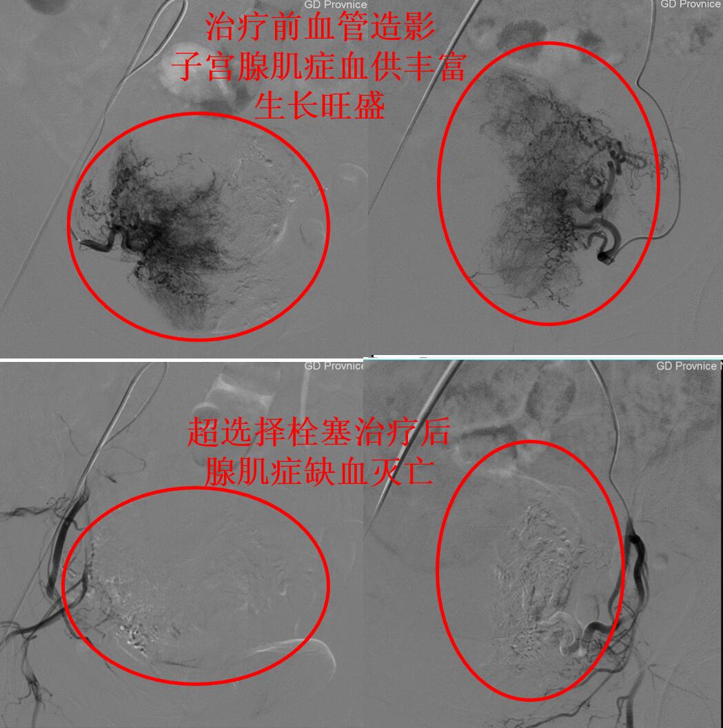 心脏做了大手术寿命能正常吗,心脏做过手术需要常年吃药吗