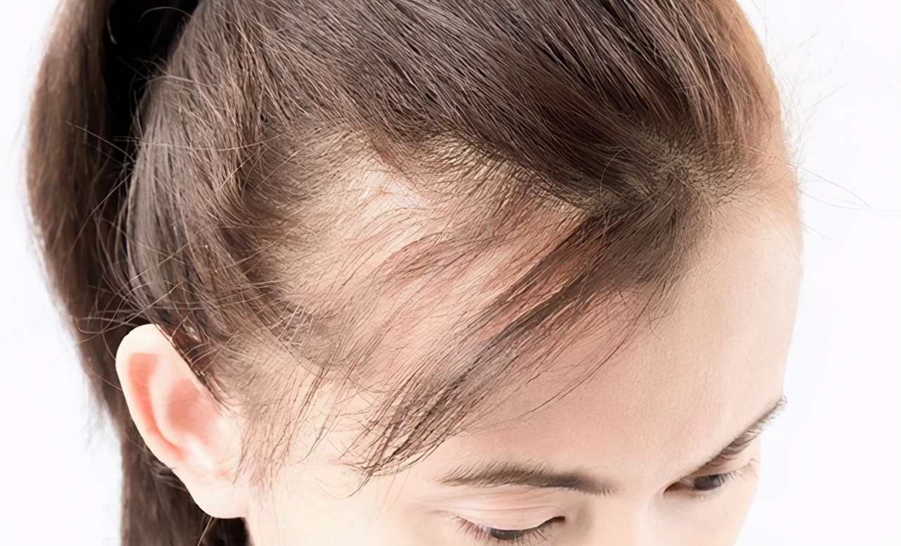 脱发不用愁教你一招改善脱发问题,脱发的原因及治疗方法你了解了吗
