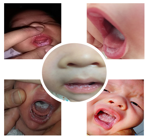 鹅口疮用了很多方法,反反复复怎么办?