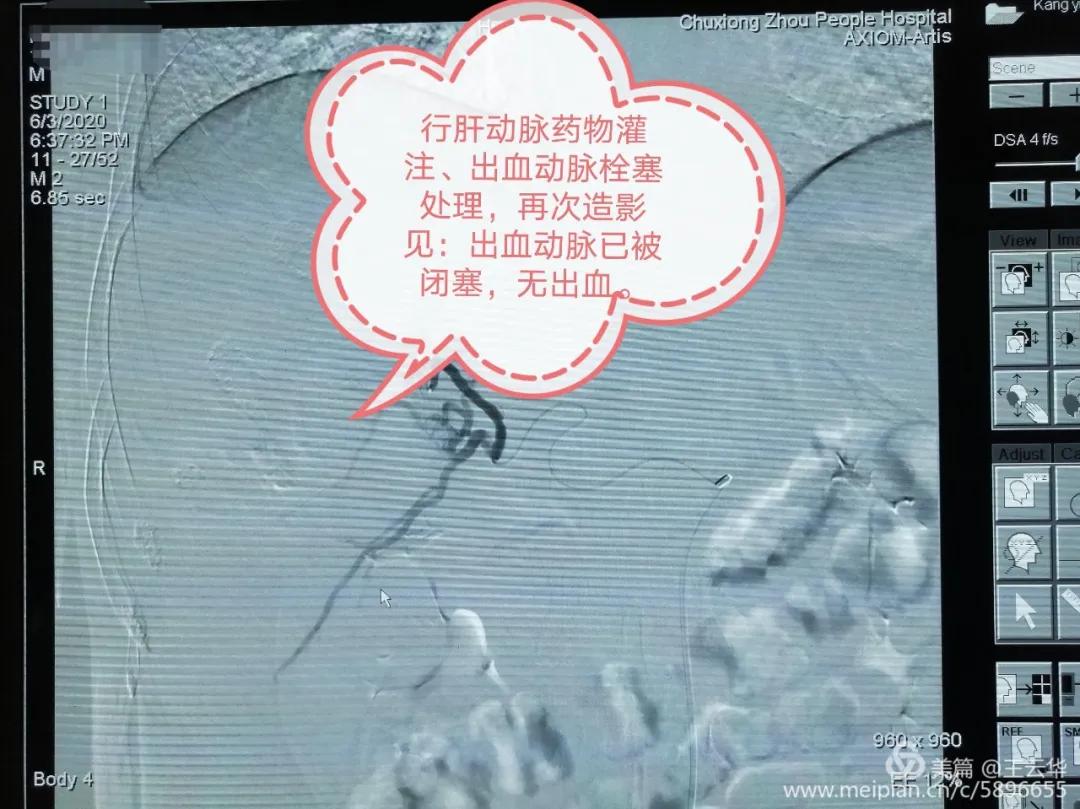 楚雄州人民医院肝胆外二科,四川省人民医院肝胆外科治疗肝癌