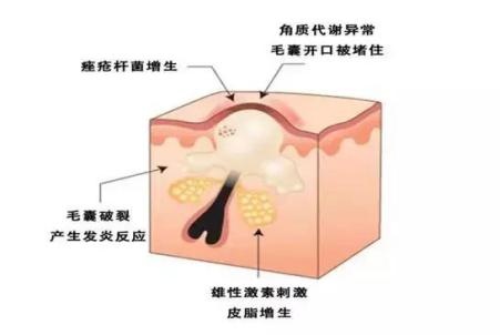 比较深的痘印怎么消除,坑坑洼洼的痘印红血丝怎么消除