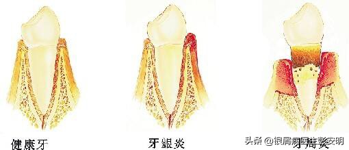 一根缝衣服的针，47岁男子拿来剔牙，剔出满头银屑病