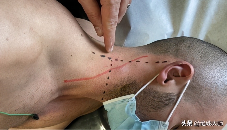 慢性颈痛推拿手法,慢性颈肩腰腿痛中医调养视频