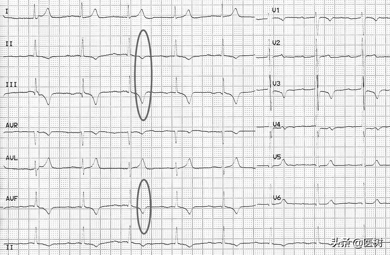 心电图t波改变是冠心病吗,心电图报告t波改变是冠心病吗