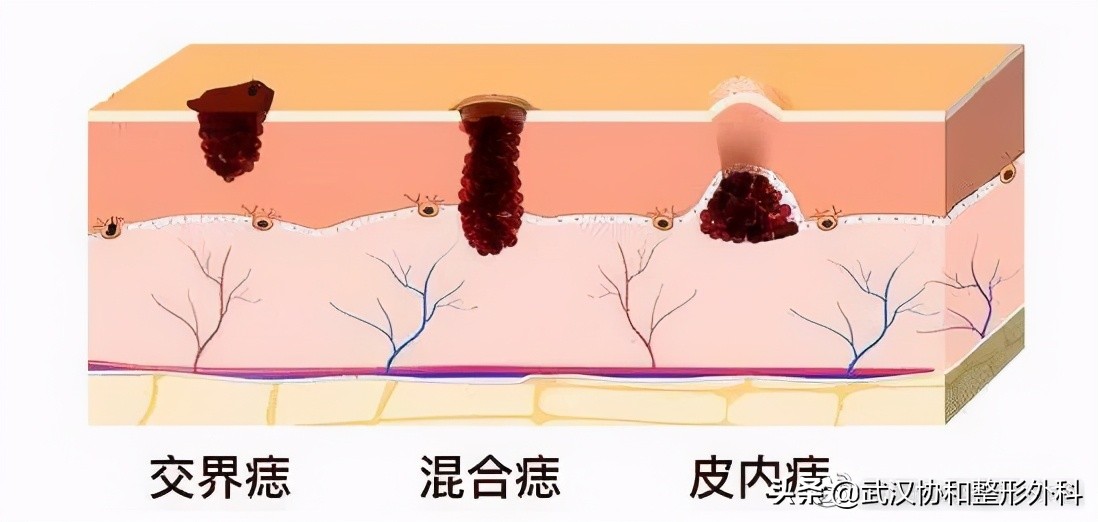 长了很多黑痣是什么原因,不规则的黑痣一定会癌变么