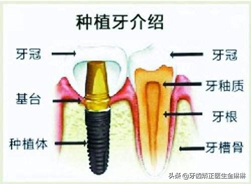 天津一颗烤瓷牙的成本是多少钱,淄博烤瓷牙一般多少钱一颗