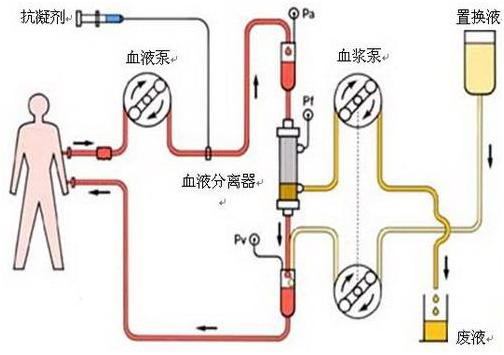 透析是怎么回事,透析是怎么回事视频