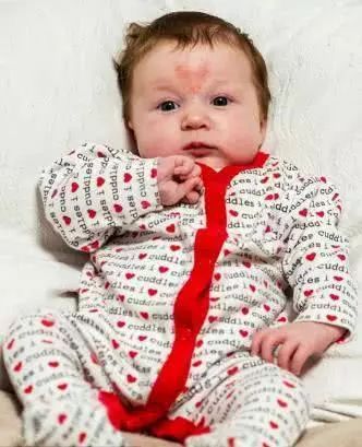 小孩身上出现红色印记,儿童身上有红色印记