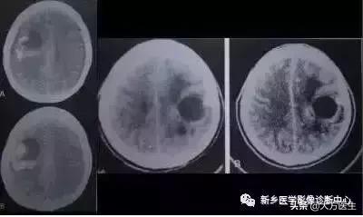 钙化灶是良性肿瘤的可能性大吗,颅内肿瘤钙化发生率最高