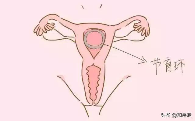 男婴手握节育环出生后续,手握避孕环的胎儿