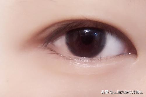 19岁全切双眼皮恢复图真实,眼修复手术