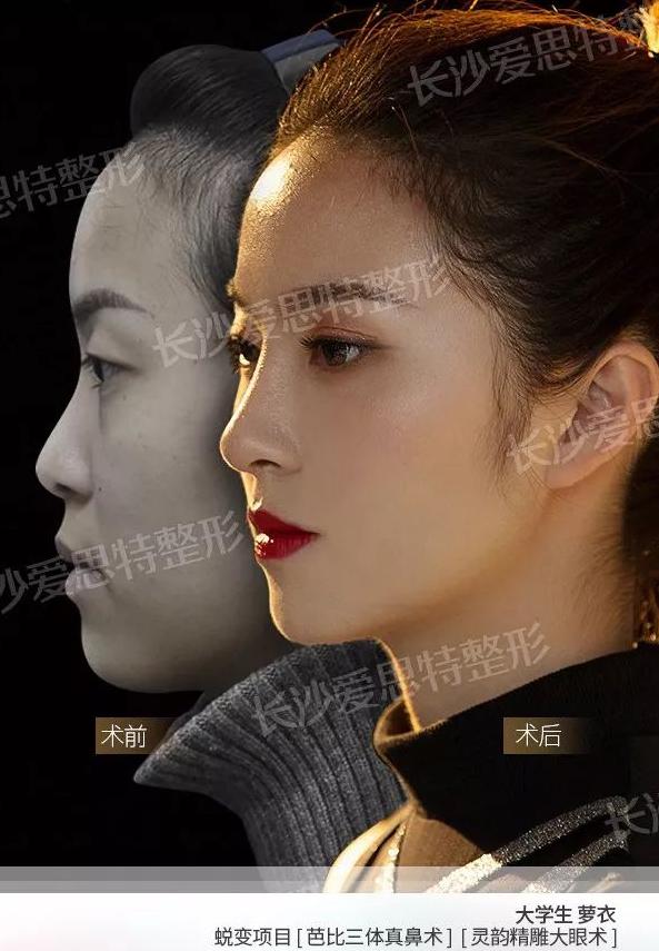 隆鼻整形手术前注意事项,隆鼻术后吃什么可以快速恢复