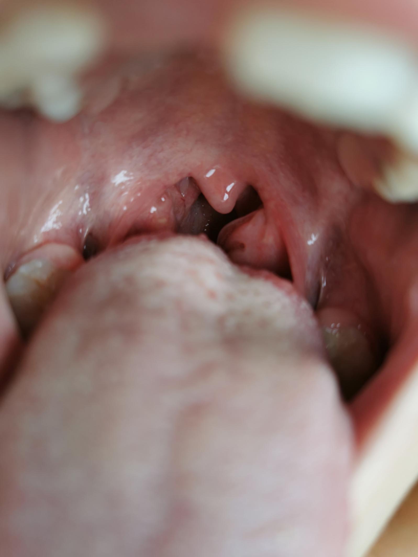 喘息一直不好什么原因,喘息咳嗽一直不好怎么办