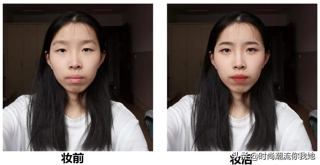 单眼皮凸嘴素人改造,肿眼泡整容成功案例