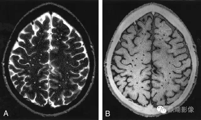 容易被误诊漏诊的脑小血管病,脑小血管病的基础知识