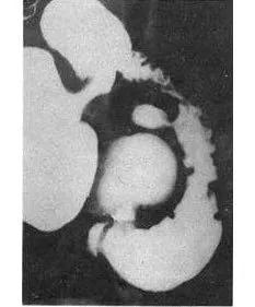 十二指肠球部溃疡解剖位置,十二指肠球部溃疡x线表现