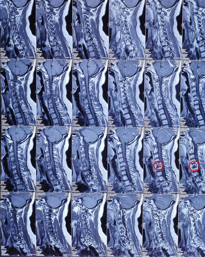 因颈背部疼痛、上臂抽疼，检查出颈5椎体结核