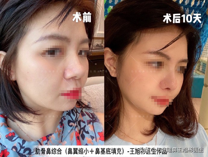 鼻头肥大矫正加鼻翼缩窄案例,鼻头缩小术后