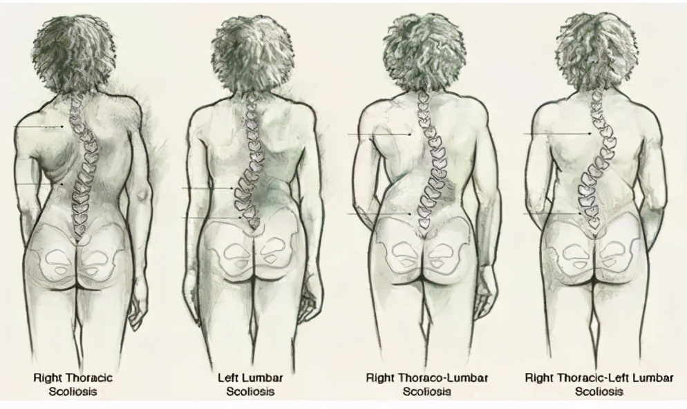 脊柱侧弯矫正后会不会压迫神经,脊柱侧弯压迫神经有什么表现