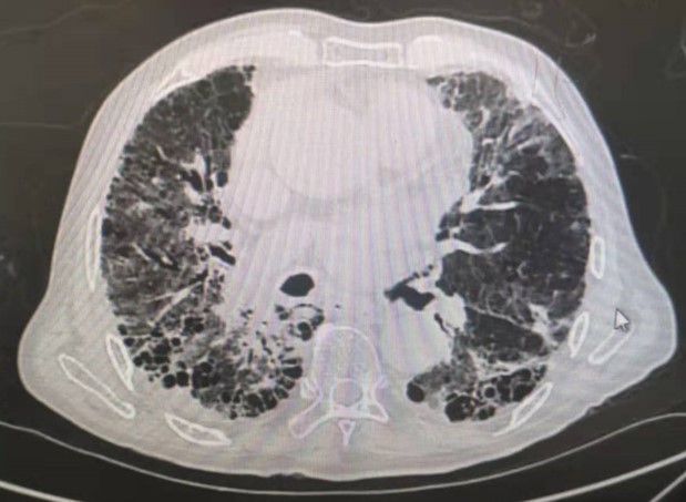 肺部5mm磨玻璃结节最新处理方法,亚实性磨玻璃结节13mmx9mm严重吗