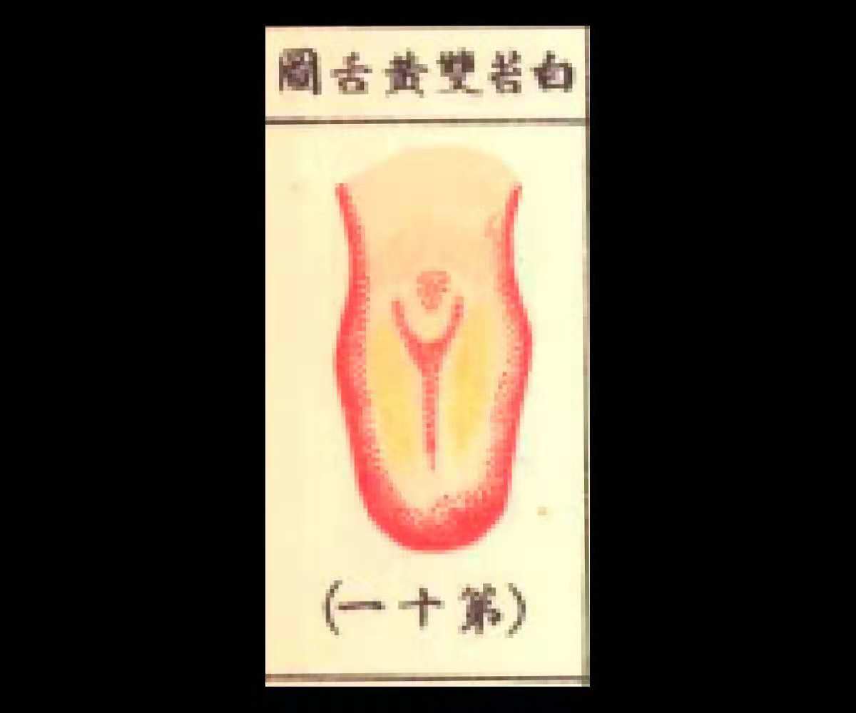 脾胃湿寒心热的舌象,白苔舌根黄