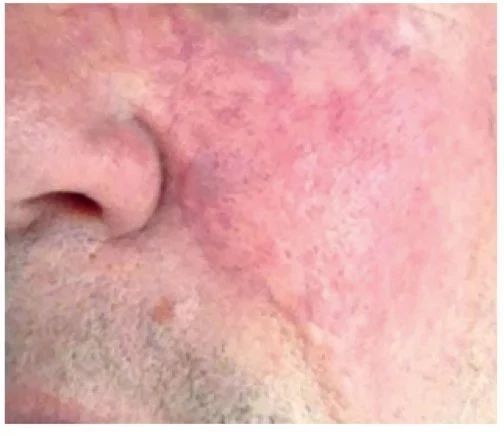 玻尿酸注射下巴的过程视频,注射玻尿酸能维持多长时间