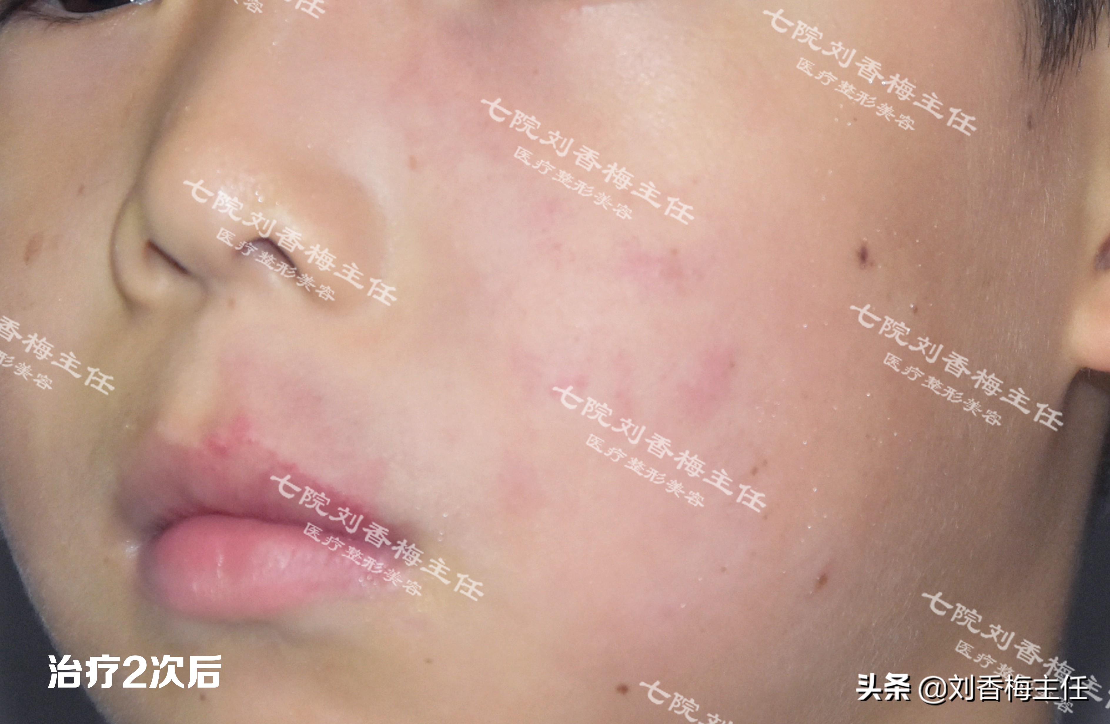 脉冲染料激光治疗鲜红斑痣治愈率,脉冲染料激光治鲜红斑痣效果