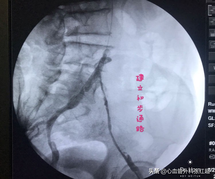 外周血管外科治疗范围,外周血管介入治疗疗程