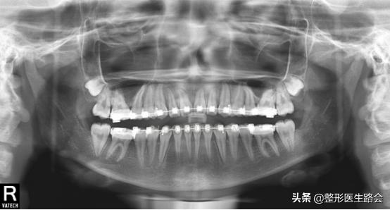 面中部凹陷下巴微翘,朱元璋式下巴怎么矫正