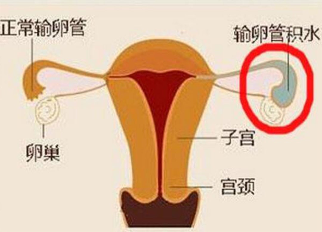 输卵管不孕是怎么回事？一篇文章搞懂输卵管不孕