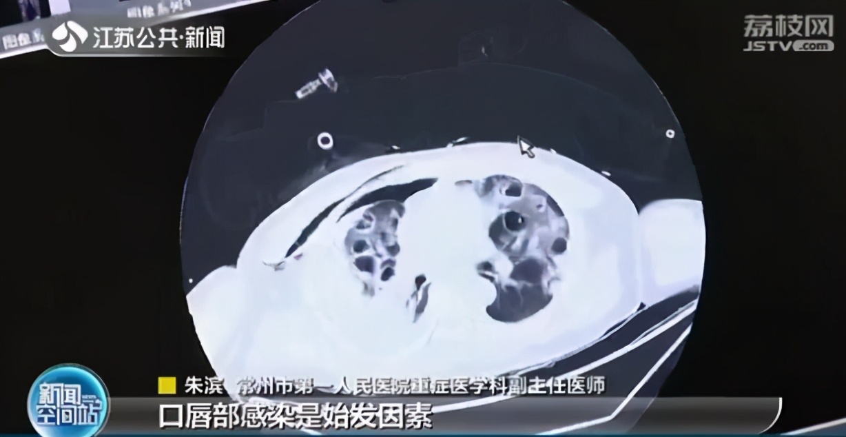 男子挤痘痘住院,男子挤痘痘引发肺部严重感染