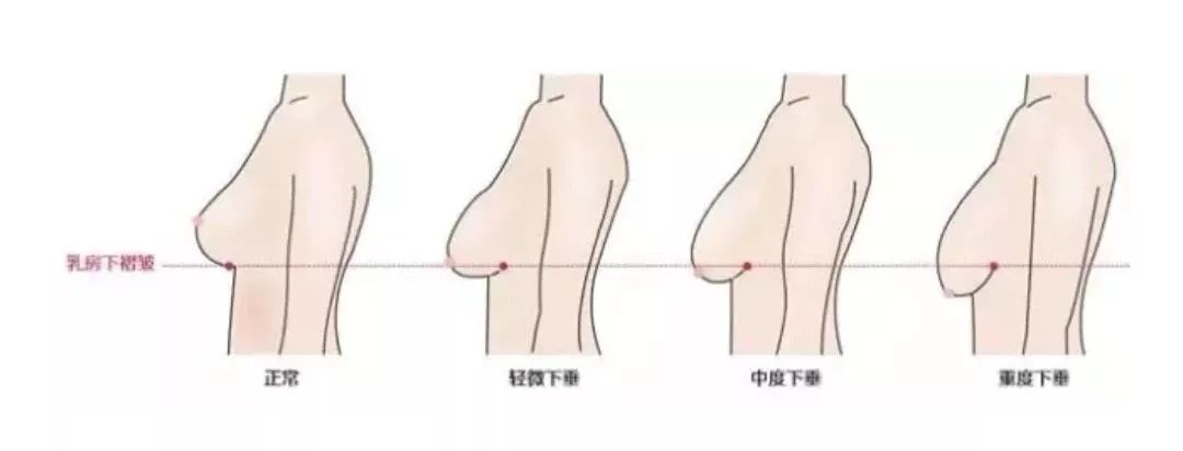 哺乳后胸部下垂怎么办,怎么预防胸部下垂
