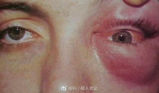 下眼睑黑眼圈特别严重是怎么回事,黑眼圈严重眼袋浮肿是什么原因