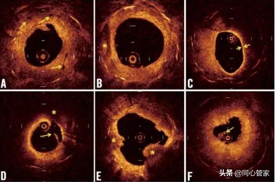 造影如何判断是血栓还是斑块,斑块和血栓ct区别