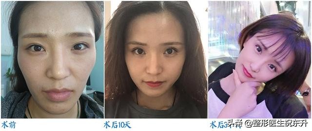 面部凹陷填充哪种方法最好,面部凹陷填充的方法有哪些