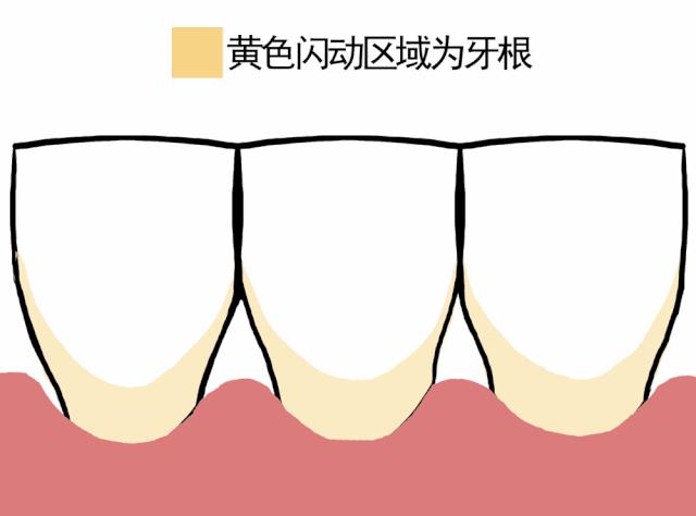 牙龈萎缩是怎么回事如何预防,预防牙龈萎缩吃什么维生素