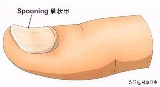 指甲的哪些变化需警惕疾病风险,指甲上有竖条纹是哪些疾病的征兆