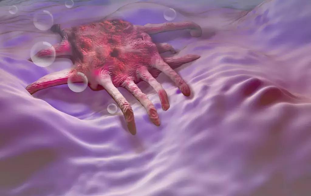 什么是乳腺不典型增生?它真的是癌前病变吗?