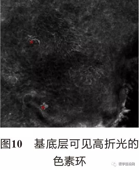 皮肤共聚焦显微镜能查什么,皮肤镜和共聚焦显微镜