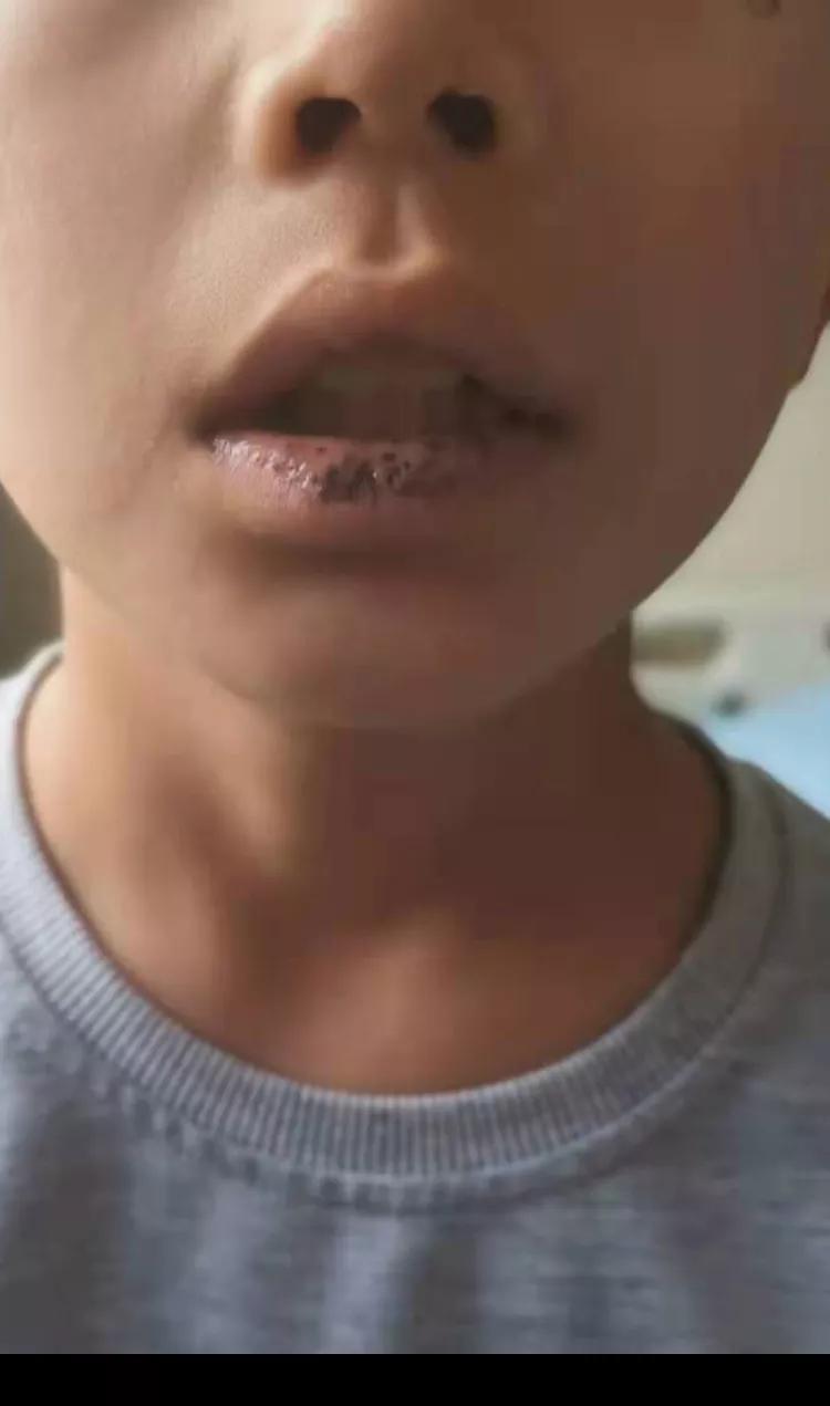 遗传病作祟11岁男孩频繁肠套叠哈尔滨市儿童医院专家：患者嘴唇有明显、大块黑斑，发病率为十万分之一