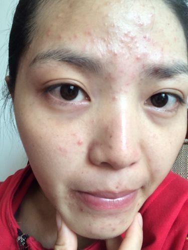 脸上痘痘红肿硬块痛怎么快速消除,脸上长很大的痘痘很痛很硬