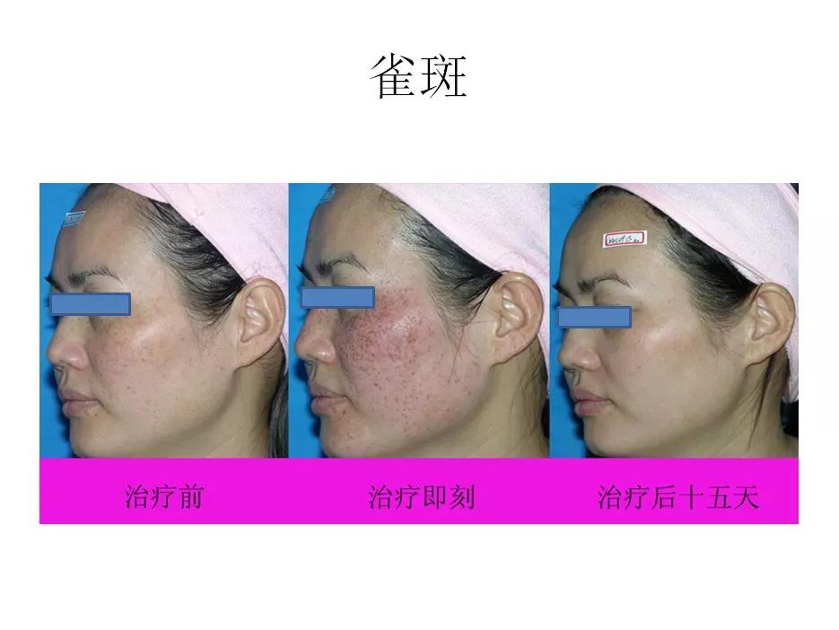 微微之光，让我记住你的美——陕西省皮防所医院超皮秒、热玛吉媒体专场活动圆满结束