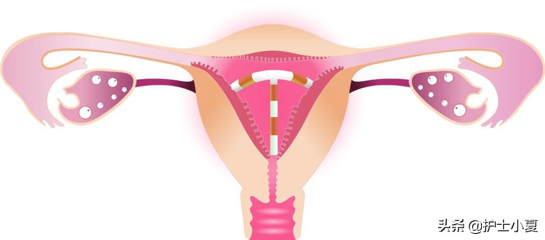 节育环可以终身不取出来吗,节育环能不能永久不取