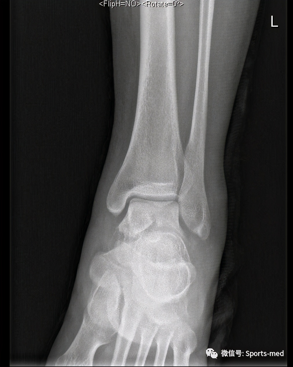 距骨软骨损伤的关节镜治疗,距骨软骨损伤关节镜手术